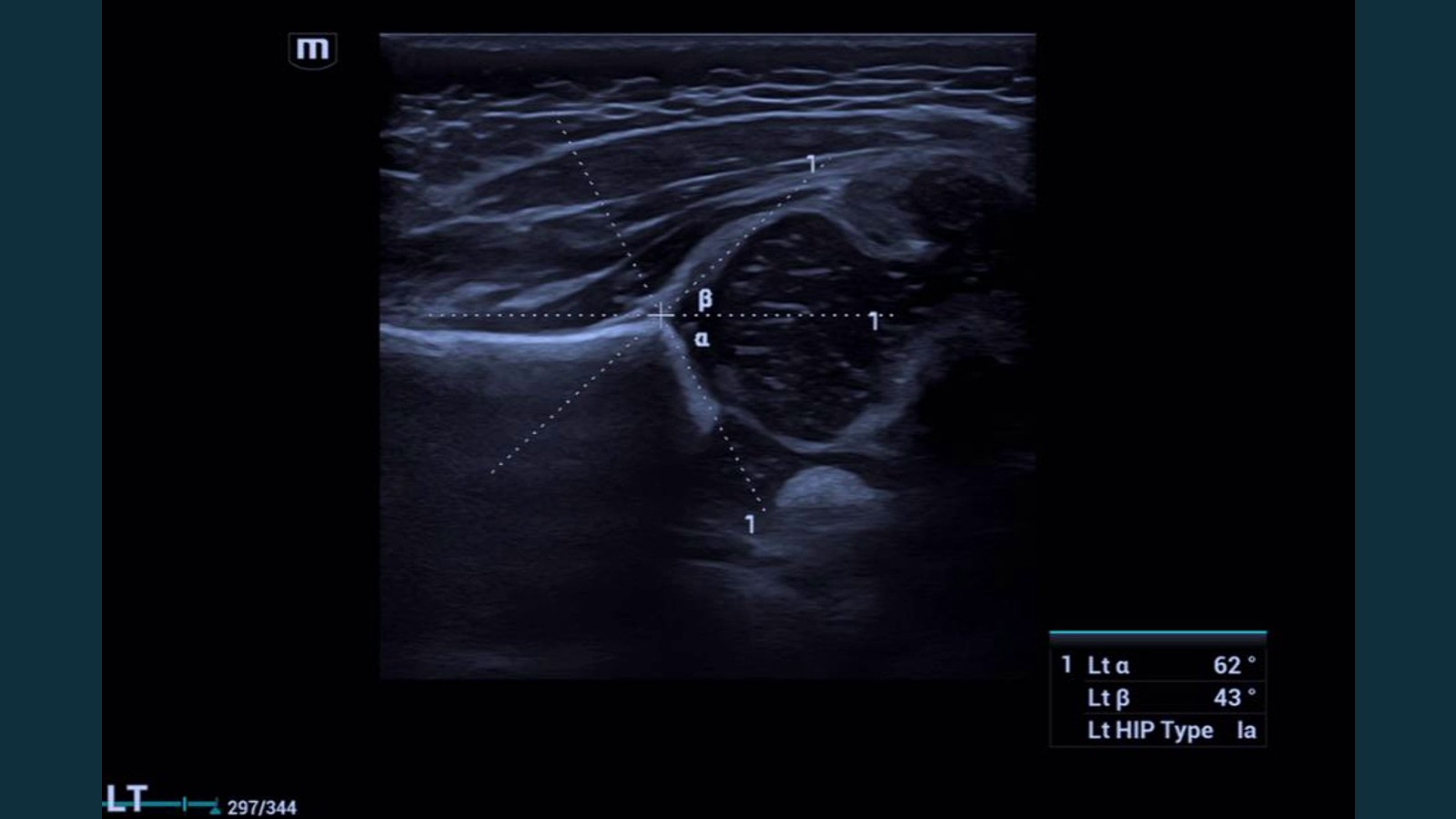Infant hip ultrasound