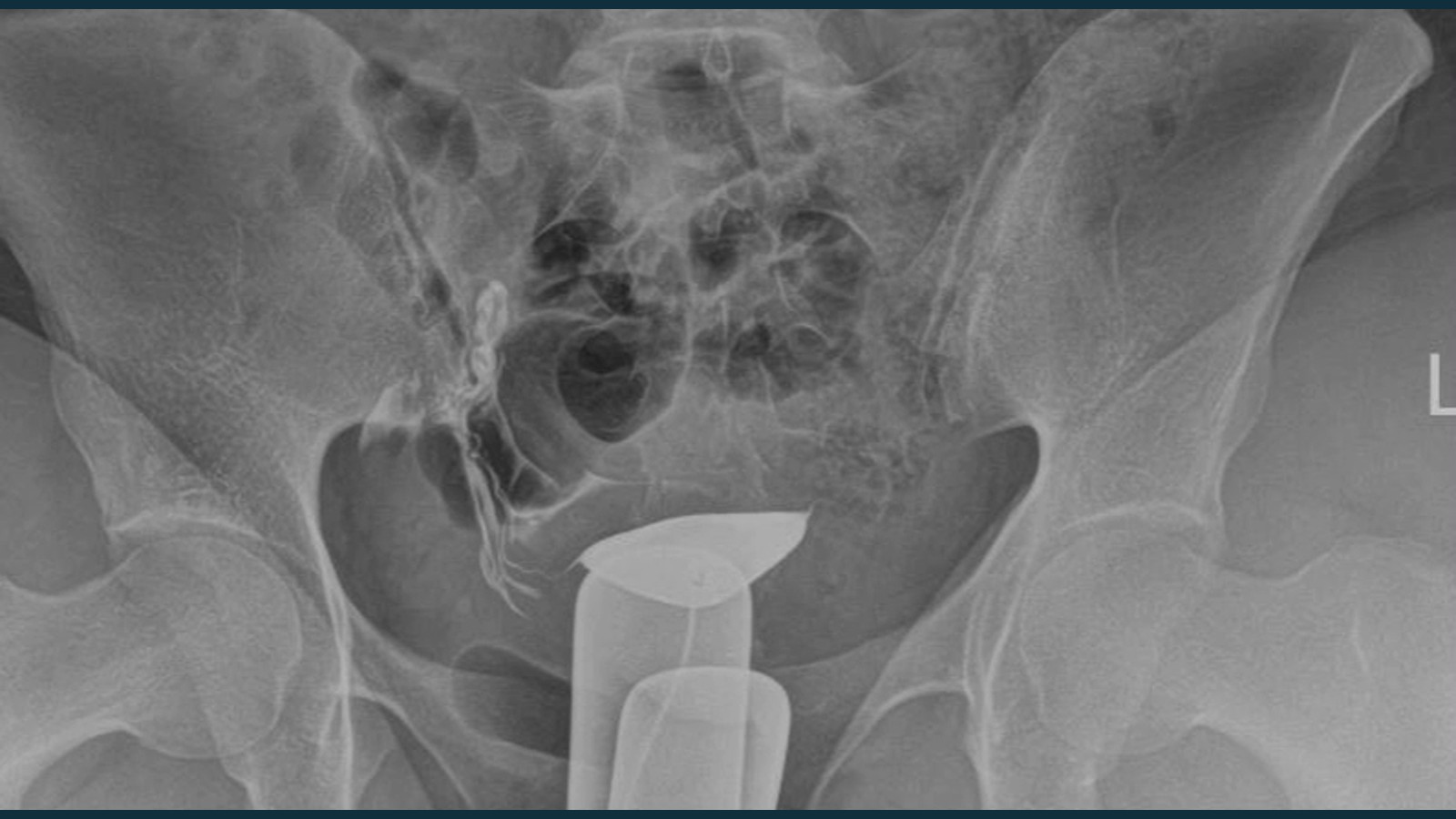 Hysterosalpingography