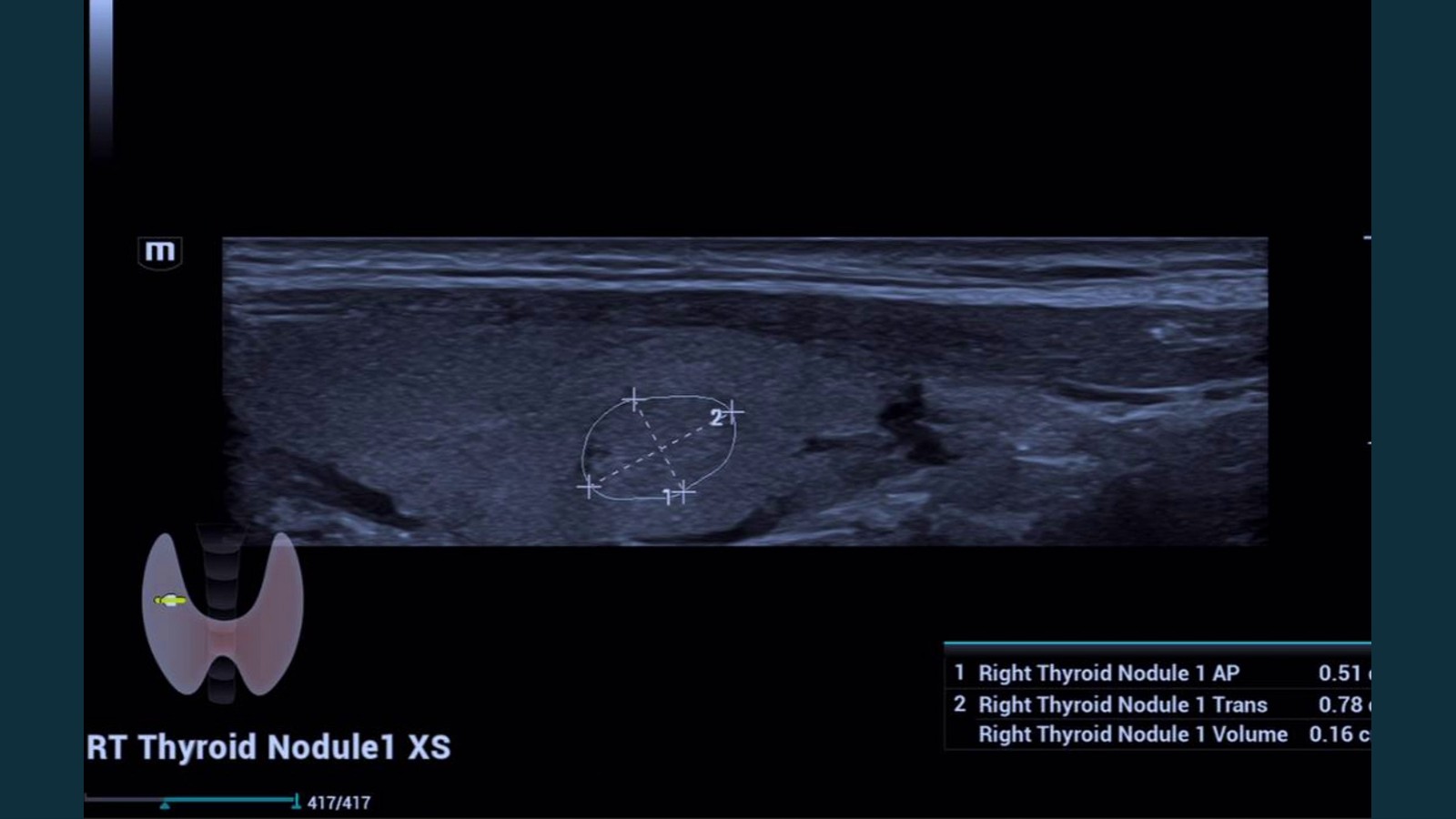 Thyroid nodule ultrasound
